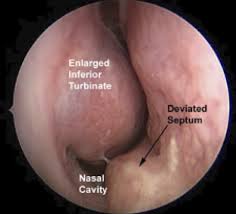 Linguistics articulated by lowering the soft palate so that air resonates in the nasal cavities and. Blocked Nasal Passage Nasal Obstruction University Of Washington Department Of Otolaryngology Head And Neck Surgery