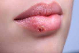 Check spelling or type a new query. Kebiasaan Penyebab Bibir Kering Dan Pecah Pecah Hello Sehat