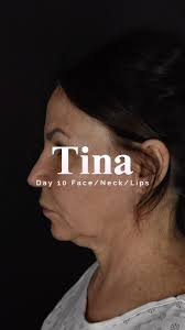 Where’s da bruising? 10 days out from #preservationfacelift and she is  looking amazingggg. The key to this recovery is minimizing skin dissection  and maximizing muscle dissection. No potential space ...