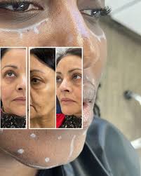 How Long Does It Take for Sunekos to Work