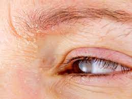 It may cause eyebrow hair loss, ingrown hair, and infections. Pimples On Eyebrows Causes Treatment And Prevention