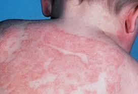 Image result for Atopic eczema atopic dermatitis