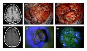 5 Aminolevulinic Acid Fluorescence In High Grade Glioma Surgery Surgical Outcome Intraoperative Findings And Fluorescence Patterns