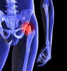 Nhs Refunded Hip Replacement Abroad Avoiding Nhs Waiting Times