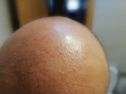 Eliminar Granitos En La Frente Dermatologia Todoexpertos Com