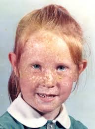 Ever heard of the Moon Child?You would not see them, because they come out  only at night. Sounds like an opening to a ghost story?(Xeroderma  Pigmentosum)