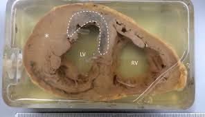 Image result for Left Ventricular Hypertrophy