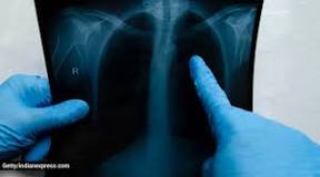 Image result for icd 10 code for small bilateral pleural effusions