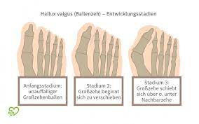 Hallux Valgus Was Hilft Wenn Die Schuhe Drucken Onmeda De