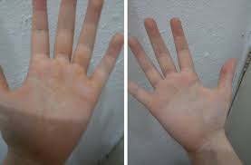 When im cold, my hands go really pale and sometimes blue. Help Orange Stains In My Left Palm What Does This Mean And What Do I Do Look At The Differences Between The Palms In The Picture Dnp