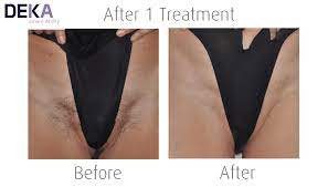 With over 16,000 treatments performed to date, laser hair removal is a safe an effective treatment to permanently remove unwanted hair on just about any part of the body. Laser Hair Removal Treatment In Chelmsford And It S Pain Free