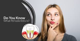 Periodontitis refers to advanced periodontal disease. Do You Know What Periodontitis Is Dental Suite