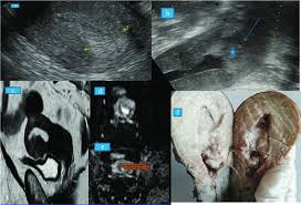 There are five stages of breast cancer, ranging from 0 to iv. 59 Year Old Female Biopsy Proved Breast Cancer Stage 4 Trans Vaginal Download Scientific Diagram
