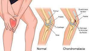 Pergelangan kaki dan kaki tersusun dari 26 tulang yang di atur dalam tiga rangkaian.tulang tarsal. Chondromalacia Patella Sakit Dikawasan Lutut Dan Penyebabnya