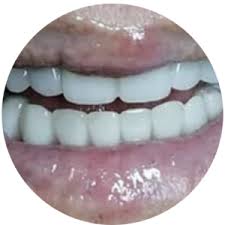 Implantes Dentales CDMX