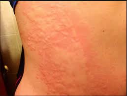 Hives, also called urticaria (yer ti care ee uh), are red, itchy, raised bumps or welts on the skin. Hives Skin Inflammation Causes Symptoms And Treatments