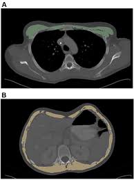 Although these changes likely represent appropriate. Ct Attenuation And Cross Sectional Area Index Of The Pectoralis Are Associated With Prognosis In Sarcoma Patients Anticancer Research