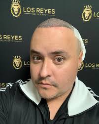 Todo fue un éxito! Gracias a mis amigos de @reyesdelinjertocdmx en unos  meses tendré cabello de rockstar 🎸. Gracias totales doctor Alejandro  Santana.com 👏🏻🙏🏻🤟🏻