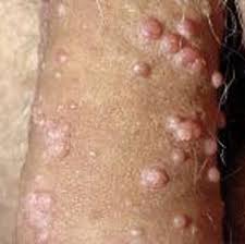 Image result for penis mycosis symptoms