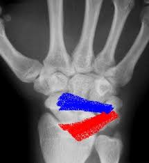 Image result for Scapholunate Dislocation