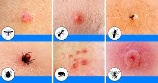How do you get rid of mosquito bites? 10 Bug Bites Anyone Should Be Able To Identify