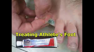 It can make your toenail change color or get thicker. Athlete S Foot What Is It How To Treat It And How To Avoid It A Must Watch Youtube
