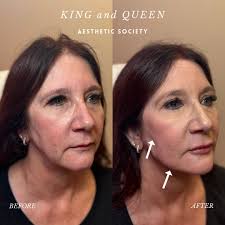 Want to achieve results like these?? Now's the perfect time with our  Juvederm & Botox June promotion! Buy 1 syringe & get 10 units free! Buy 2  syringe & get 20 units