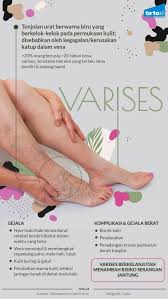 Vena varikos adalah keadaan di mana saluran darah yang paling dekat dengan permukaan kulit mengalami pelebaran dan pembengkakan. Waspadai Varises Vagina Saat Hamil Dan Cara Mengatasinya