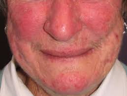 Entdecke rezepte, einrichtungsideen, stilinterpretationen und andere ideen zum ausprobieren. Rosacea Dermnet Nz
