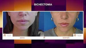 La bichectomía en colombia y especialmente en bogotá se plantea como una alternativa de cirugía maxilofacial con resultados estéticos efectivos, que serán vistos entre el día 30 y 45 del postoperatorio y al que muchos pacientes le han dado el si. Bichectomia Precio En 2021 Guia Completa Operacion Cachetes