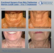 Surgery Free Laser Skin Tightening With The Starlux Luxir Laser The Below Results Were Achieved After 5 To 7 Laser Skin Tightening Laser Skin Skin Tightening
