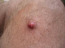 When skin cancer is found early, it can be treated more easily. Skin Cancer Tanner Foot Ankle Clinics 801 773 4865 Gary N Oaks Dpm