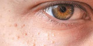 Image result for milium cyst on eyelid