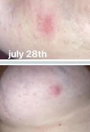 Image result for Inflammatory breast cancer