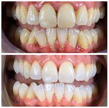 Before & After Gallery L London Dental Hygienist