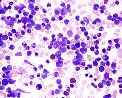 Complete blood count (cbc) & peripheral blood film. 3 844 Leukemia Photos Free Royalty Free Stock Photos From Dreamstime