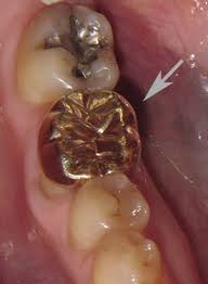 The gold itself won't rot your teeth. A Comparison Of Dental Crown Materials Portland Or Dr Martha Rich Dmd A Comparison Of Dental Crown Materials Dentist Portland Or