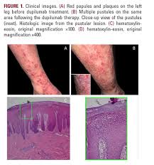 Image result for Pustular Psoriasis