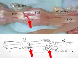 Flexor digitorum profundus (fdp) tendons fdp tendons help bend the index, middle, ring, and small fingers at the fingertip joint. Closed Disruption Of A Single Flexor Digitorum Superficialis Tendon Slip 3 Cases Sciencedirect