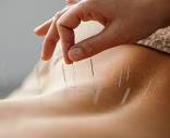 Acupuncture: What To Know