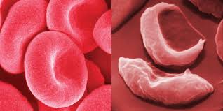 Image result for Anemia angolensis