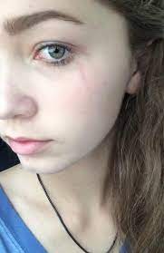 Caity On Twitter My Dog Scratched My Face And Just Missed My Eye Nice Http T Co W9zctujvbt Twitter