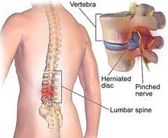 Jazzman riffs on britten's piano. Low Cost Herniated Disc Surgery In India Affordable Herniated Disc Surgery