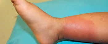 Image result for erysipel photos)