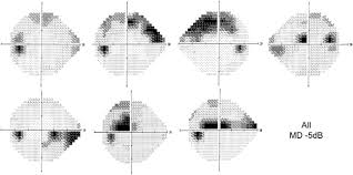 Image result for Visual Field Deficit