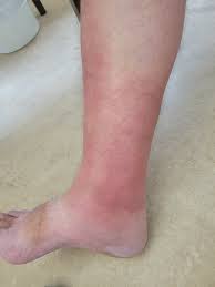 Image result for erysipel photos)