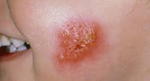 Image result for Impetigo