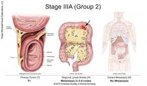 Stage iv means the cancer has spread to other parts of your body. Colorectal Cancer Stages Cancer Net