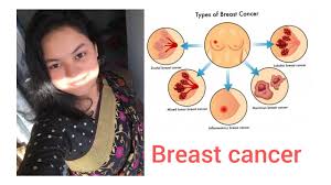 They all have one message: Breast Cancer Singns Symptoms Precusion Breastcare Bangla Youtube