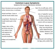Resultado de imagem para LUPUS